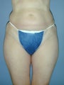 Liposuction
