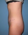 Tummy tuck to flatten tummy
