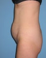 Tummy tuck to flatten tummy