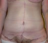 50 year old woman has Belt Lipectomy