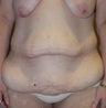 50 year old woman has Belt Lipectomy