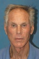 Men's Facelift