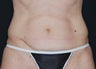 Liposuction