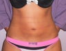 29 year old woman has Liposuction 