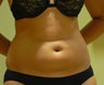 29 year old woman has Liposuction 
