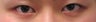 Bilateral Asian Eyelid Surgery