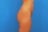 Brazilian Butt Lift