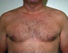 Male Breast Reduction