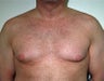 Male Breast Reduction