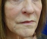 Juvederm