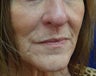 Juvederm