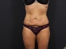 Liposuction Abdomen & Flanks