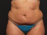 Liposuction Abdomen & Flanks