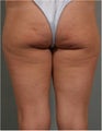 41 year old female treated for Cellulite on the back of her legs and bottocks using Cellulaze technologiy