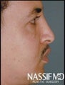 Male Middle Eastern Rhinoplasty 