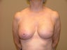 Breast Reconstruction