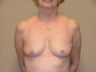 Breast Reconstruction