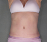 Tummy Tuck with Lipo to Flanks