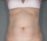 Tummy Tuck with Lipo to Flanks