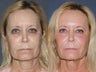 58 year old female treated with Ultra Repair Laser Resurfacing