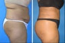 Cleveland buttock augmentation with fat grafting