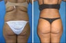 Cleveland buttock augmentation with fat grafting
