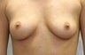 Breast Augmentation