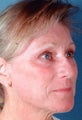 Full face laser skin resurfacing