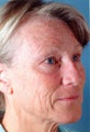 Full face laser skin resurfacing