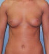 27-Year-Old Female Breast Augmentation