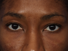 Restylane