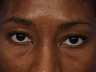 Restylane