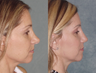 Rhinoplasty