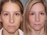 Rhinoplasty