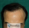 Norwood VI after 3750 FUE Hair Transplant