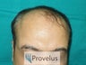 Norwood VI after 3750 FUE Hair Transplant
