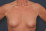 Breast Augmentation Large implants