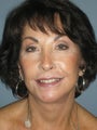 67 y/o. Lite Lift Modified Face Lift , Temple  & Eye lidLift