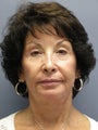 67 y/o. Lite Lift Modified Face Lift , Temple  & Eye lidLift