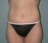 Female patient who underwent a tummy tuck 