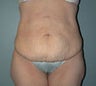 Female patient who underwent a tummy tuck 