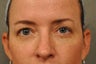 41 Year Old Female with Under Eye Shadows