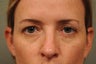 41 Year Old Female with Under Eye Shadows