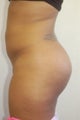 Buttock Enhancement2