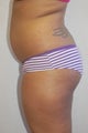 Buttock Enhancement2