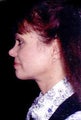 Neck Liposuction