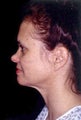 Neck Liposuction