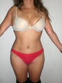 Tummy Tuck