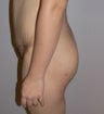 This 25 year old woman had liposuction around the buttocks and a medium sized butt implant 