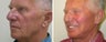 Facelift Before & After Photos